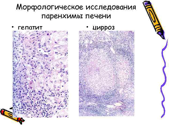 Морфологическое исследования паренхимы печени • гепатит • цирроз 