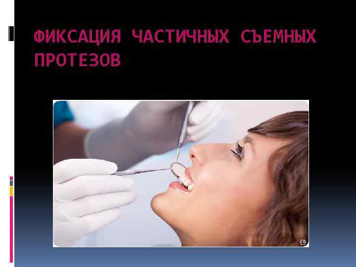 ФИКСАЦИЯ ЧАСТИЧНЫХ СЪЕМНЫХ ПРОТЕЗОВ 