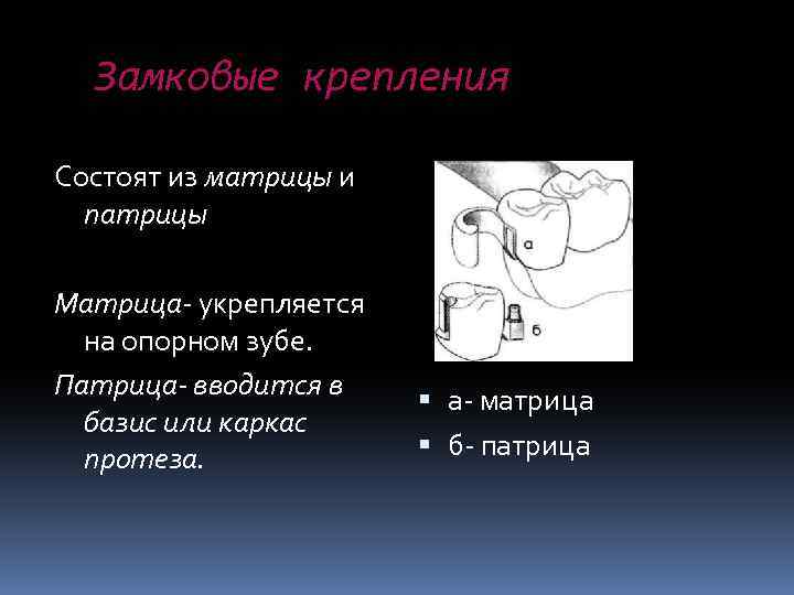  Замковые крепления Состоят из матрицы и патрицы Матрица- укрепляется на опорном зубе. Патрица-
