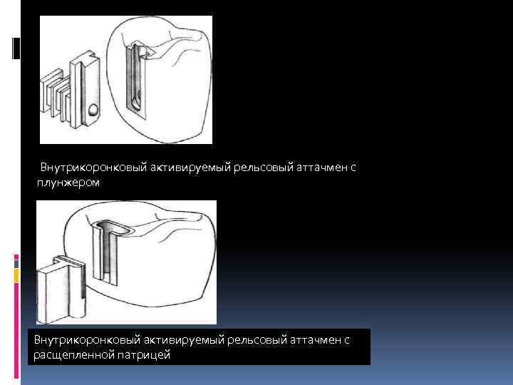  Внутрикоронковый активируемый рельсовый аттачмен с плунжером Внутрикоронковый активируемый рельсовый аттачмен с расщепленной патрицей