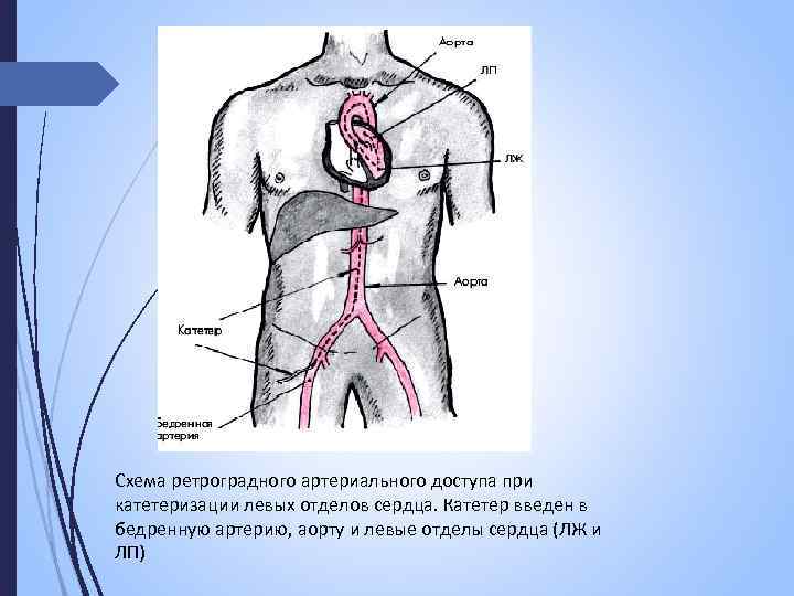 Схема ретроградного артериального доступа при катетеризации левых отделов сердца. Катетер введен в бедренную артерию,