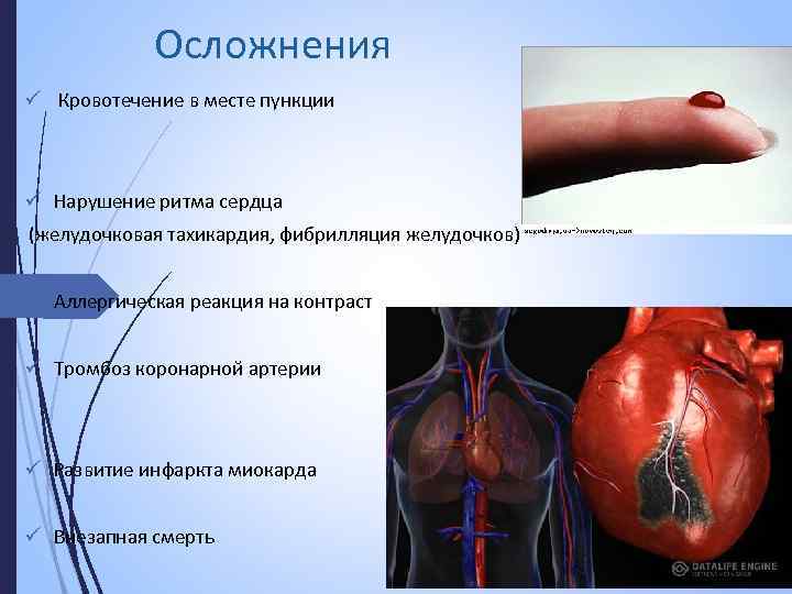  Осложнения ü Кровотечение в месте пункции ü Нарушение ритма сердца (желудочковая тахикардия, фибрилляция