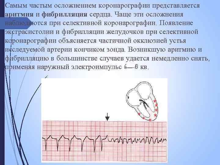 Самым частым осложнением коронарографии представляется аритмия и фибрилляция сердца. Чаще эти осложнения наблюдаются при