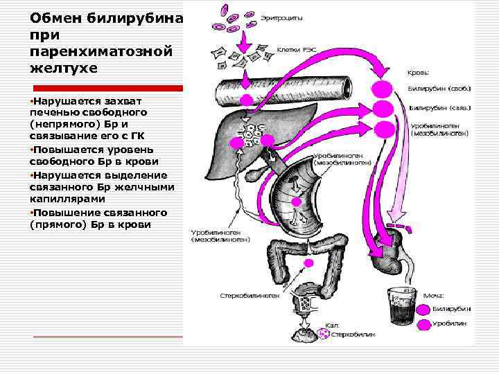 Обмен билирубина при паренхиматозной желтухе • Нарушается захват печенью свободного (непрямого) Бр и связывание