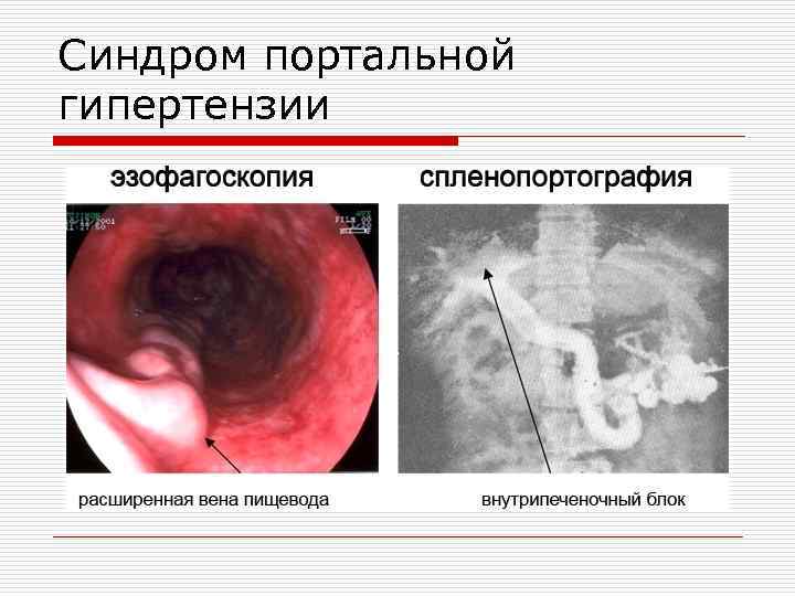 Синдром портальной гипертензии 