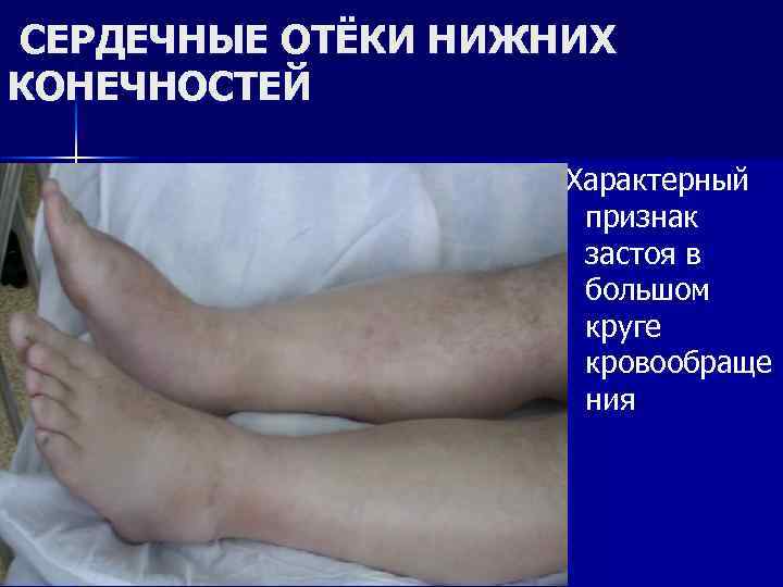 СЕРДЕЧНЫЕ ОТЁКИ НИЖНИХ КОНЕЧНОСТЕЙ Характерный признак застоя в большом круге кровообраще ния 