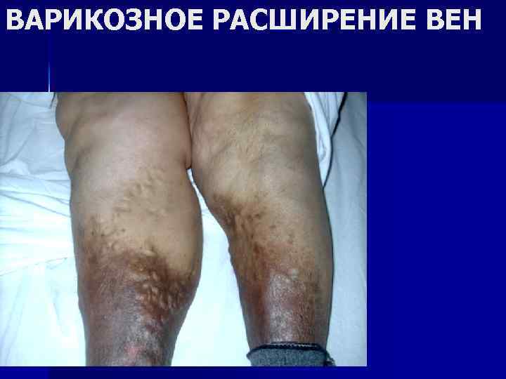 ВАРИКОЗНОЕ РАСШИРЕНИЕ ВЕН 
