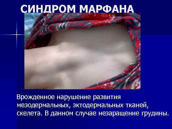 СИНДРОМ МАРФАНА Врожденное нарушение развития мезодермальных, эктодермальных тканей, скелета. В данном случае незаращение грудины.