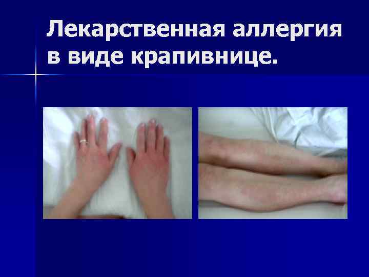 Лекарственная аллергия в виде крапивнице. 