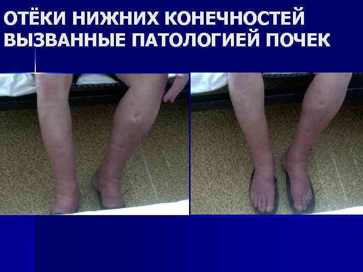 ОТЁКИ НИЖНИХ КОНЕЧНОСТЕЙ ВЫЗВАННЫЕ ПАТОЛОГИЕЙ ПОЧЕК 