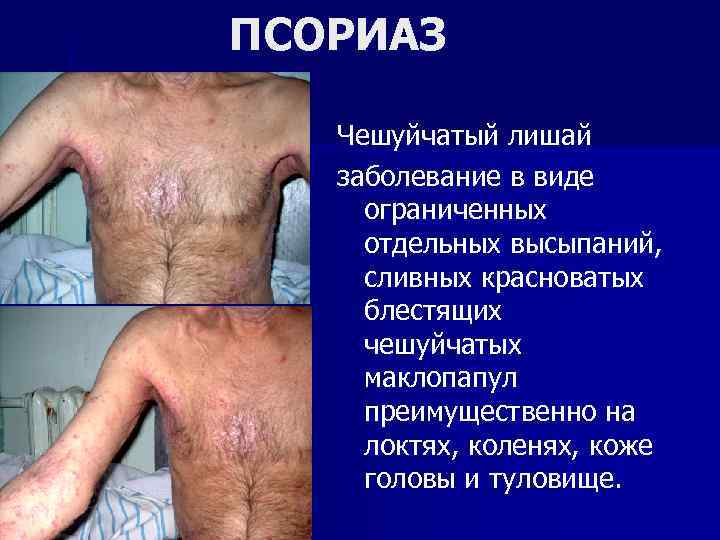 ПСОРИАЗ Чешуйчатый лишай заболевание в виде ограниченных отдельных высыпаний, сливных красноватых блестящих чешуйчатых маклопапул