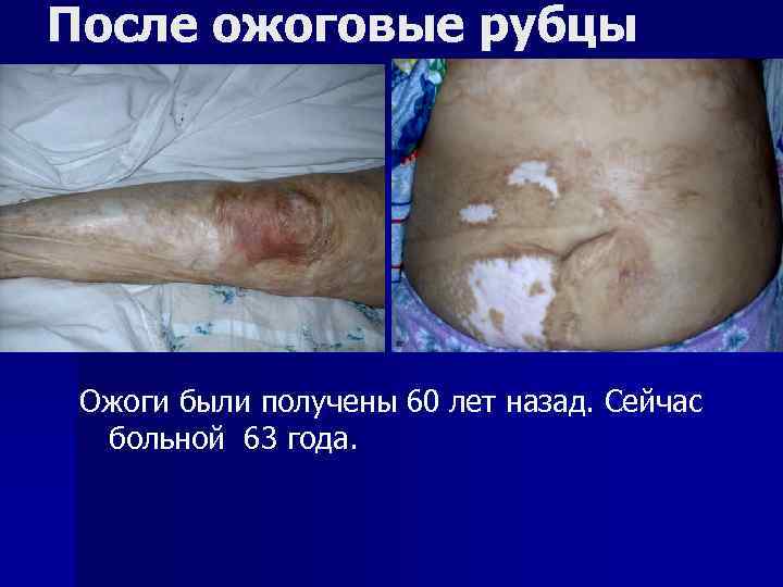 После ожоговые рубцы Ожоги были получены 60 лет назад. Сейчас больной 63 года. 