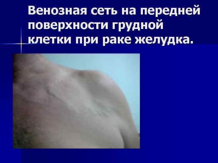 Венозная сеть на передней поверхности грудной клетки при раке желудка. 