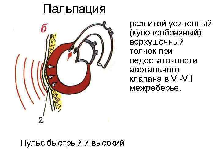 Пальпация разлитой усиленный (куполообразный) верхушечный толчок при недостаточности аортального клапана в VI VII межреберье.