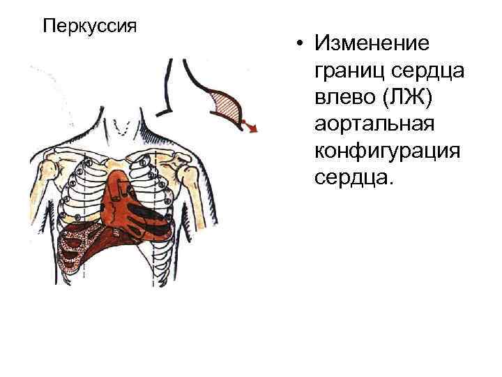 Перкуссия • Изменение границ сердца влево (ЛЖ) аортальная конфигурация сердца. 