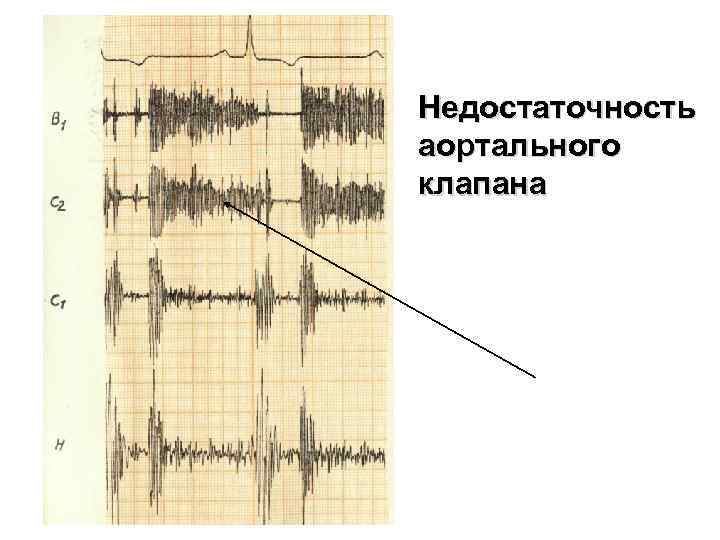 Недостаточность аортального клапана 