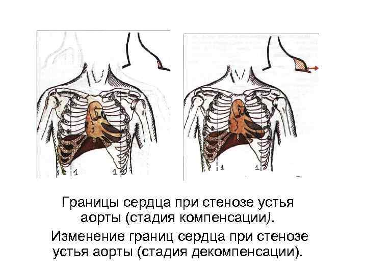 Границы сердца при стенозе устья аорты (стадия компенсации). Изменение границ сердца при стенозе устья