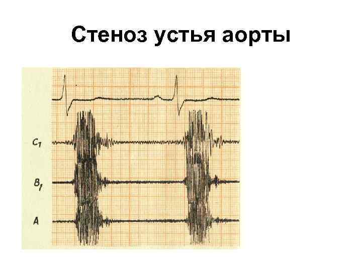 Стеноз устья аорты 