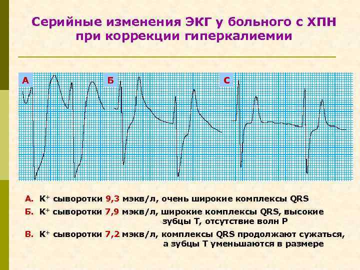 Серийные изменения ЭКГ у больного с ХПН при коррекции гиперкалиемии А Б С A.