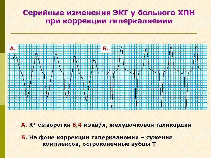 Серийные изменения ЭКГ у больного ХПН при коррекции гиперкалиемии А. Б. А. K+ сыворотки