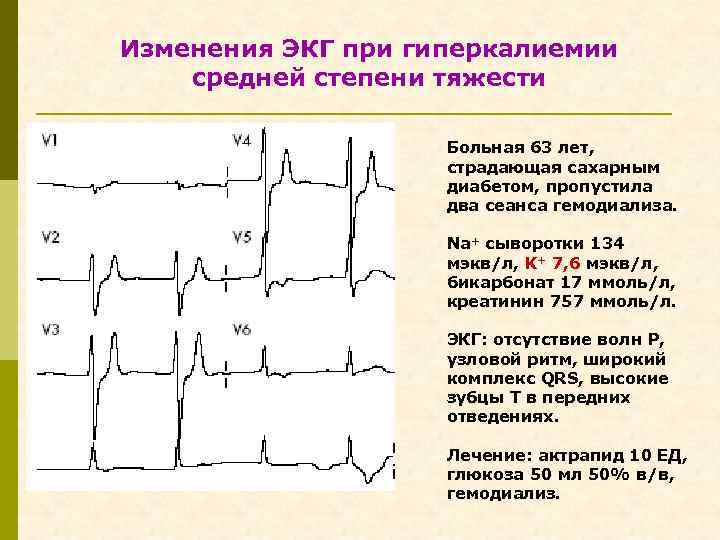 Изменения ЭКГ при гиперкалиемии средней степени тяжести Больная 63 лет, страдающая сахарным диабетом, пропустила