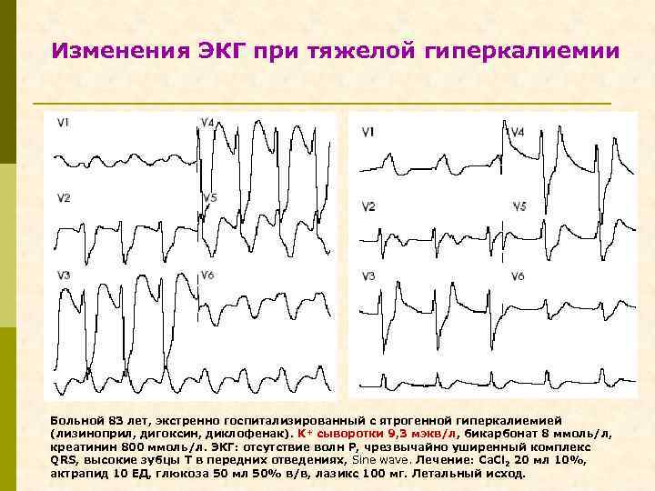 Изменения ЭКГ при тяжелой гиперкалиемии Больной 83 лет, экстренно госпитализированный с ятрогенной гиперкалиемией (лизиноприл,