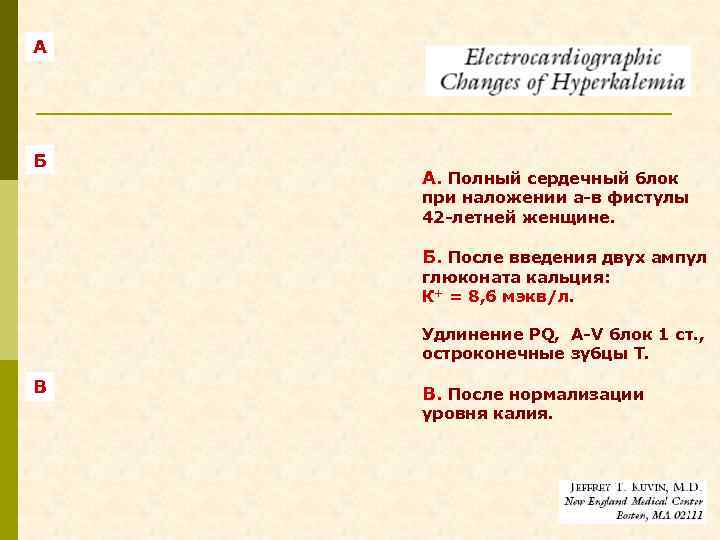 А Б А. Полный сердечный блок при наложении а-в фистулы 42 -летней женщине. Б.