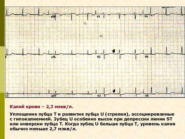 Калий крови – 2, 3 мэкв/л. Уплощение зубца Т и развитие зубца U (стрелки),