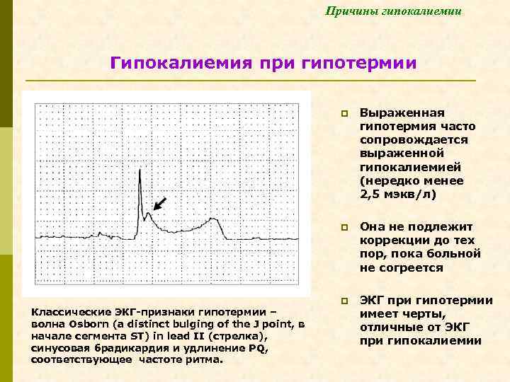 Причины гипокалиемии Гипокалиемия при гипотермии p p Классические ЭКГ-признаки гипотермии – волна Osborn (a