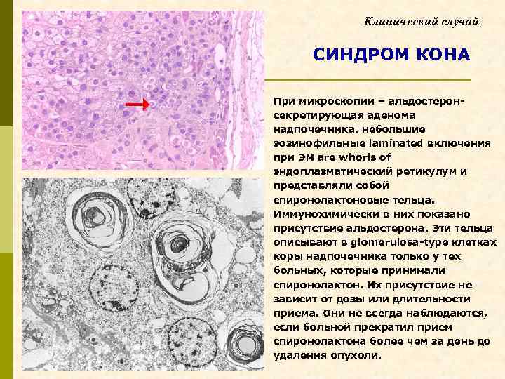 Клинический случай СИНДРОМ КОНА При микроскопии – альдостеронсекретирующая аденома надпочечника. небольшие эозинофильные laminated включения