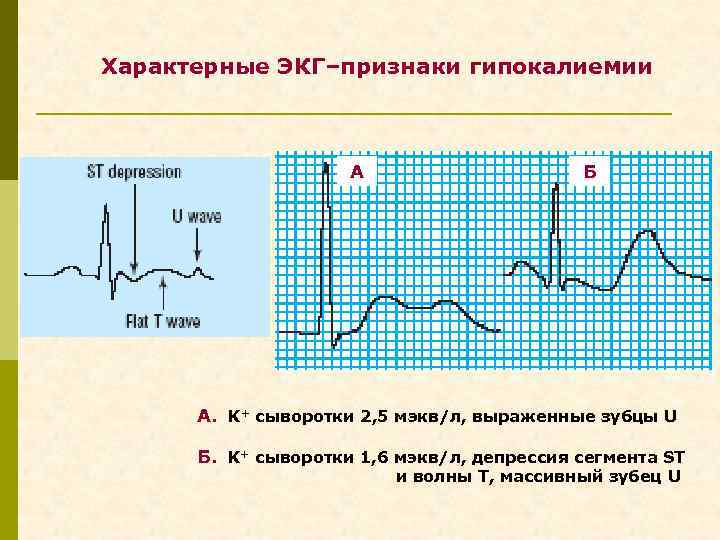 Характерные ЭКГ–признаки гипокалиемии А Б А. K+ сыворотки 2, 5 мэкв/л, выраженные зубцы U