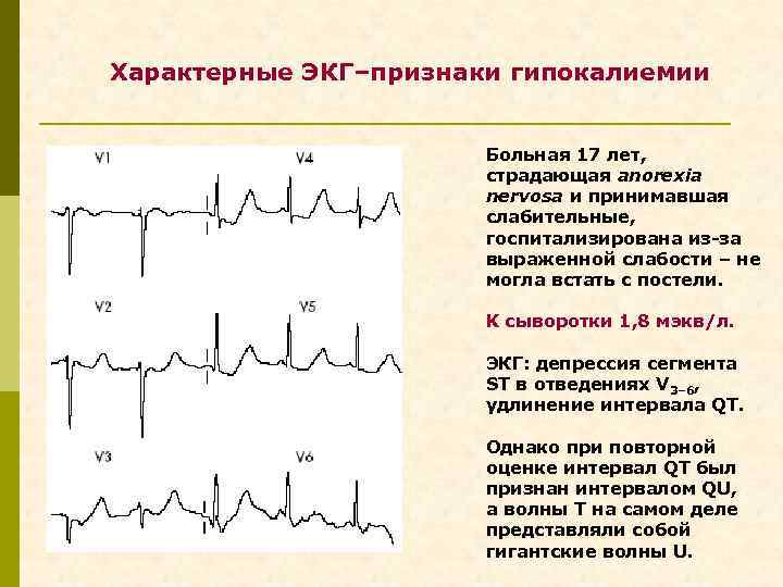 Характерные ЭКГ–признаки гипокалиемии Больная 17 лет, страдающая anorexia nervosa и принимавшая слабительные, госпитализирована из-за