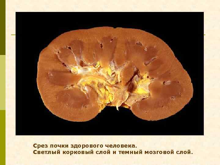 Срез почки здорового человека. Светлый корковый слой и темный мозговой слой. 