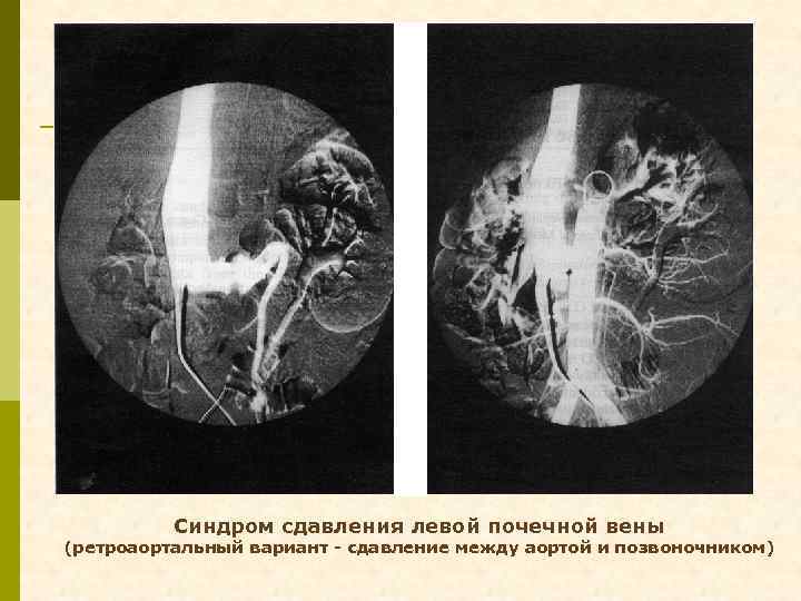 Синдром сдавления левой почечной вены (ретроаортальный вариант - сдавление между аортой и позвоночником) 