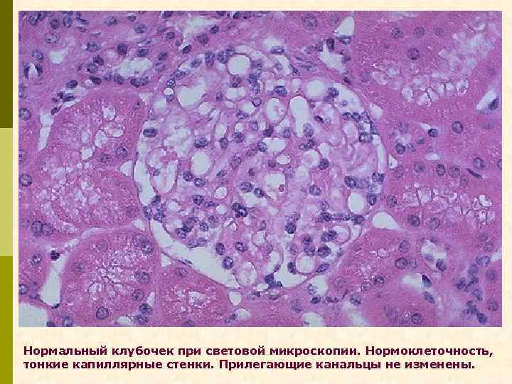 Нормальный клубочек при световой микроскопии. Нормоклеточность, тонкие капиллярные стенки. Прилегающие канальцы не изменены. 