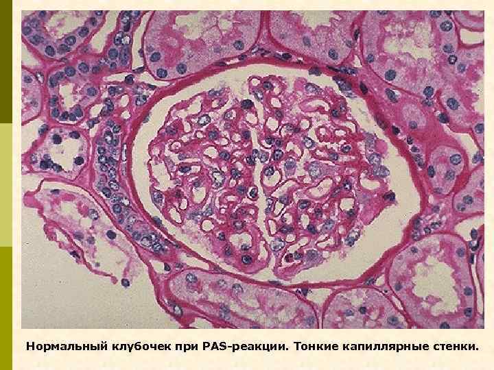 Нормальный клубочек при PAS-реакции. Тонкие капиллярные стенки. 