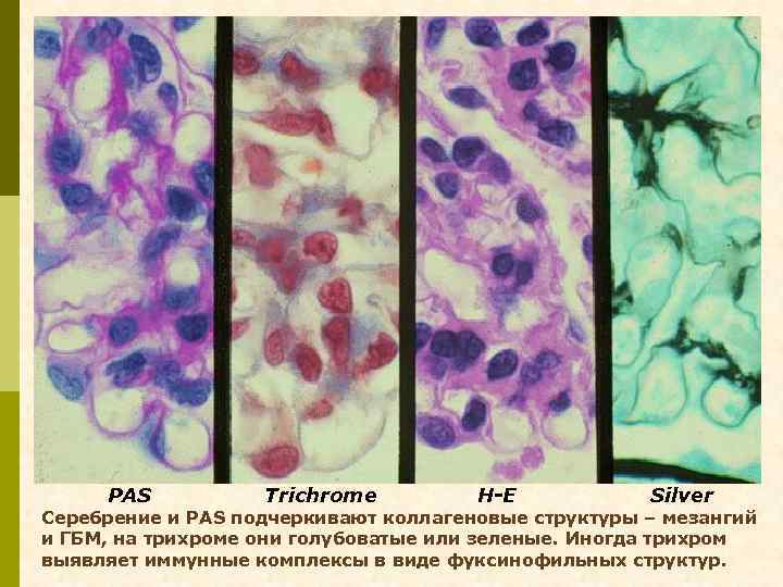 PAS Trichrome H-E Silver Cеребрение и PAS подчеркивают коллагеновые структуры – мезангий и ГБМ,