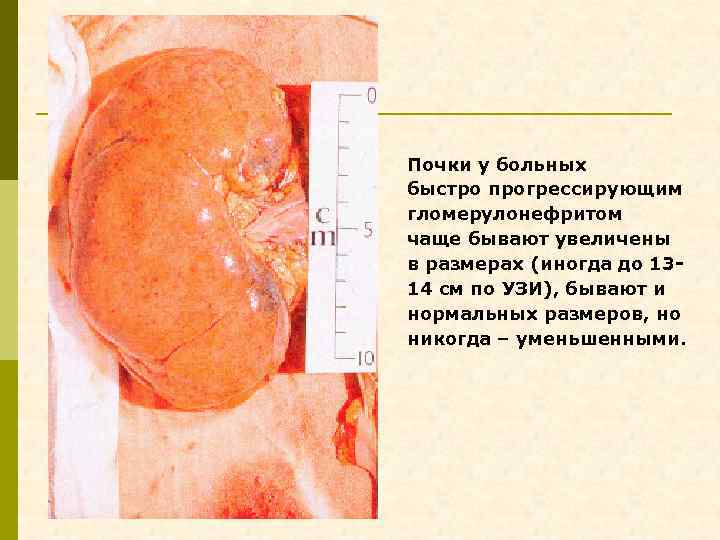 Почки у больных быстро прогрессирующим гломерулонефритом чаще бывают увеличены в размерах (иногда до 1314