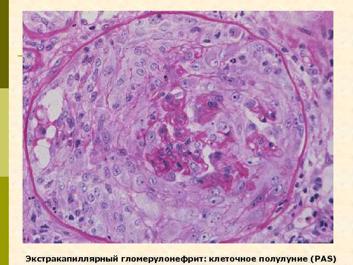 Экстракапиллярный гломерулонефрит: клеточное полулуние (PAS) 