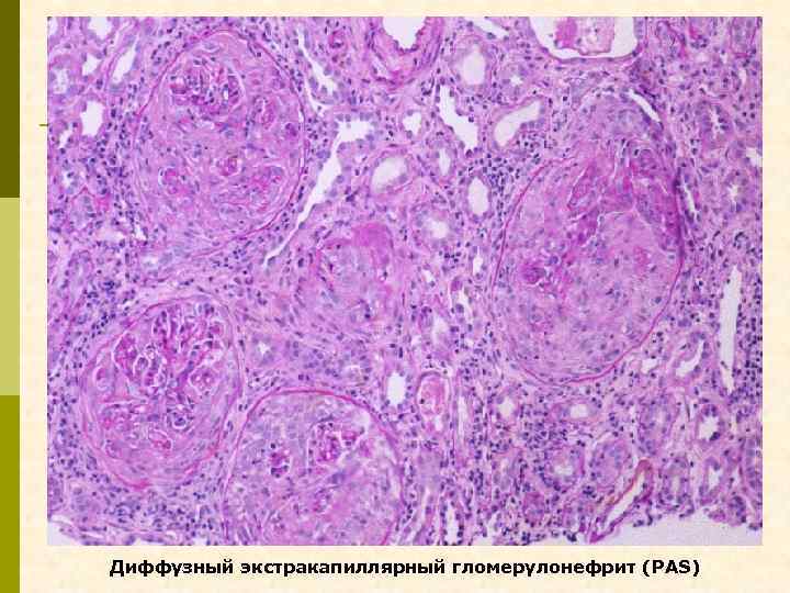 Диффузный экстракапиллярный гломерулонефрит (PAS) 