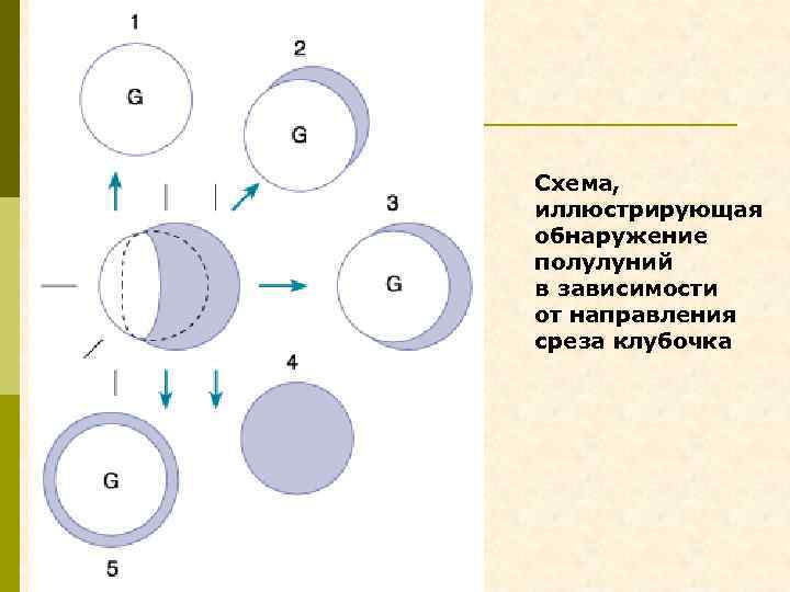 Схема, иллюстрирующая обнаружение полулуний в зависимости от направления среза клубочка 