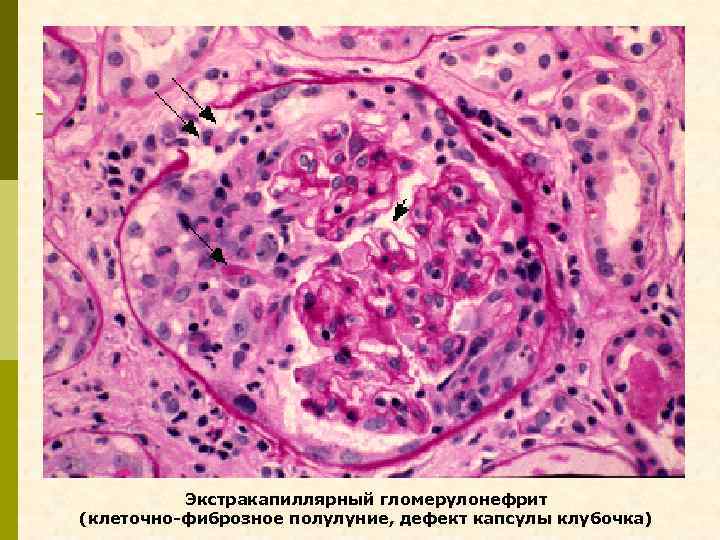 Экстракапиллярный гломерулонефрит (клеточно-фиброзное полулуние, дефект капсулы клубочка) 