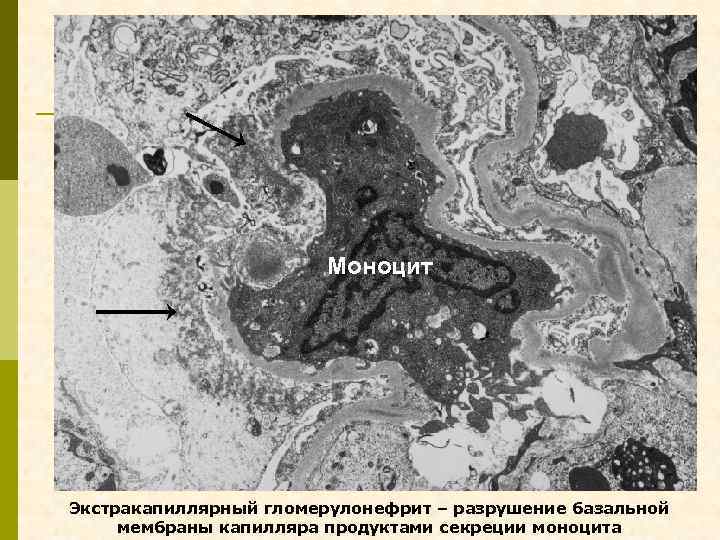 Моноцит Экстракапиллярный гломерулонефрит – разрушение базальной мембраны капилляра продуктами секреции моноцита 