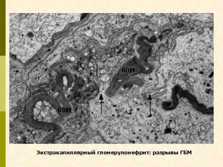 Экстракапиллярный гломерулонефрит: разрывы ГБМ 