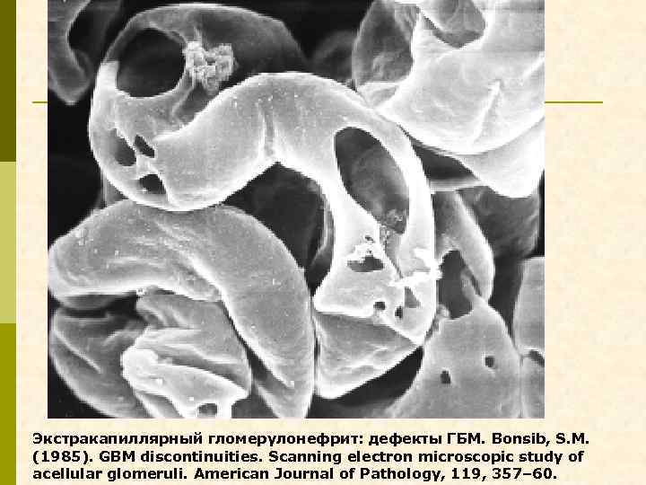 Экстракапиллярный гломерулонефрит: дефекты ГБМ. Bonsib, S. M. (1985). GBM discontinuities. Scanning electron microscopic study