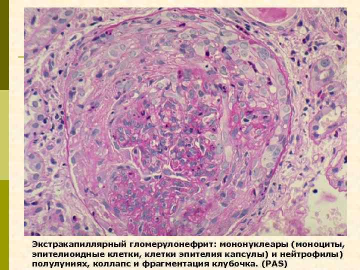 Экстракапиллярный гломерулонефрит: мононуклеары (моноциты, эпителиоидные клетки, клетки эпителия капсулы) и нейтрофилы) полулуниях, коллапс и