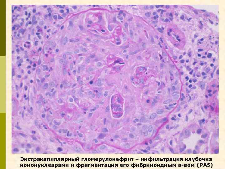 Экстракапиллярный гломерулонефрит – инфильтрация клубочка мононуклеарами и фрагментация его фибриноидным в-вом (PAS) 