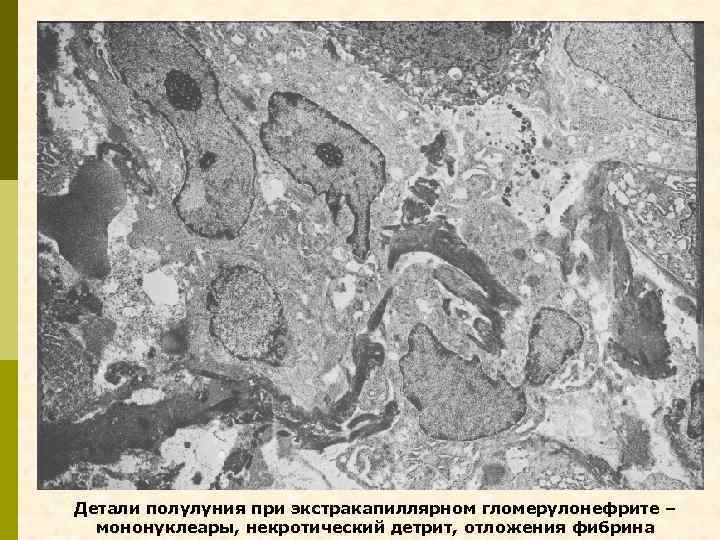 Детали полулуния при экстракапиллярном гломерулонефрите – мононуклеары, некротический детрит, отложения фибрина 