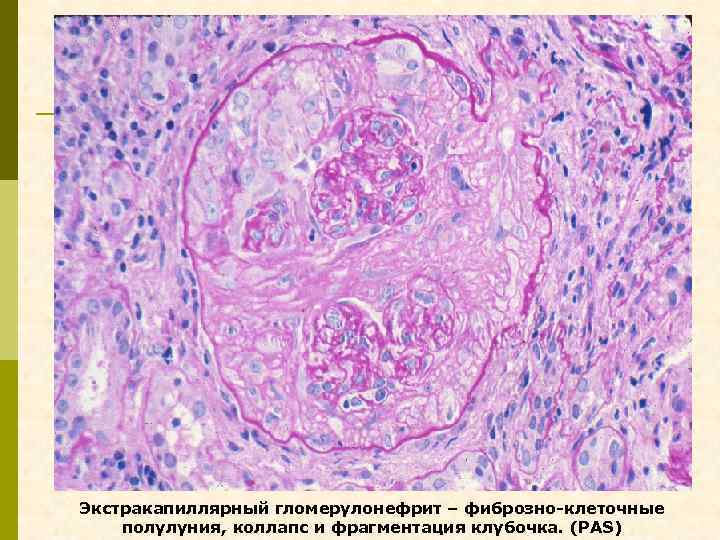 Экстракапиллярный гломерулонефрит – фиброзно-клеточные полулуния, коллапс и фрагментация клубочка. (PAS) 