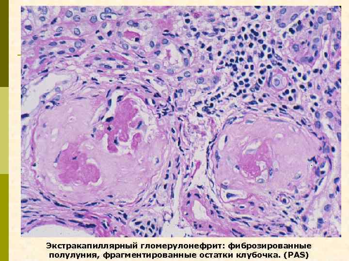 Экстракапиллярный гломерулонефрит: фиброзированные полулуния, фрагментированные остатки клубочка. (PAS) 